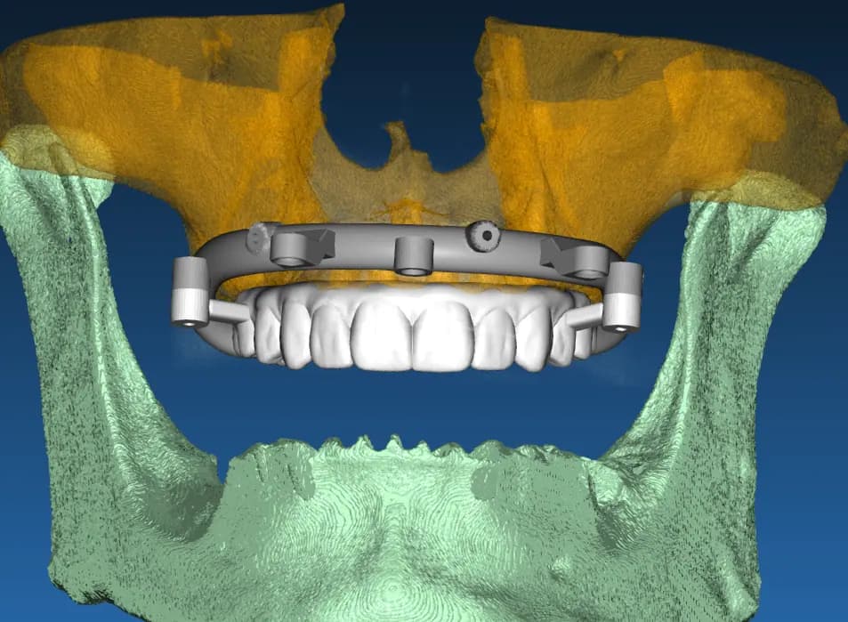 All-on-X surgical guide between upper and lower jaw rendered from CBCT data, designed by MyNaviScan for a Chicago-area dental clinic