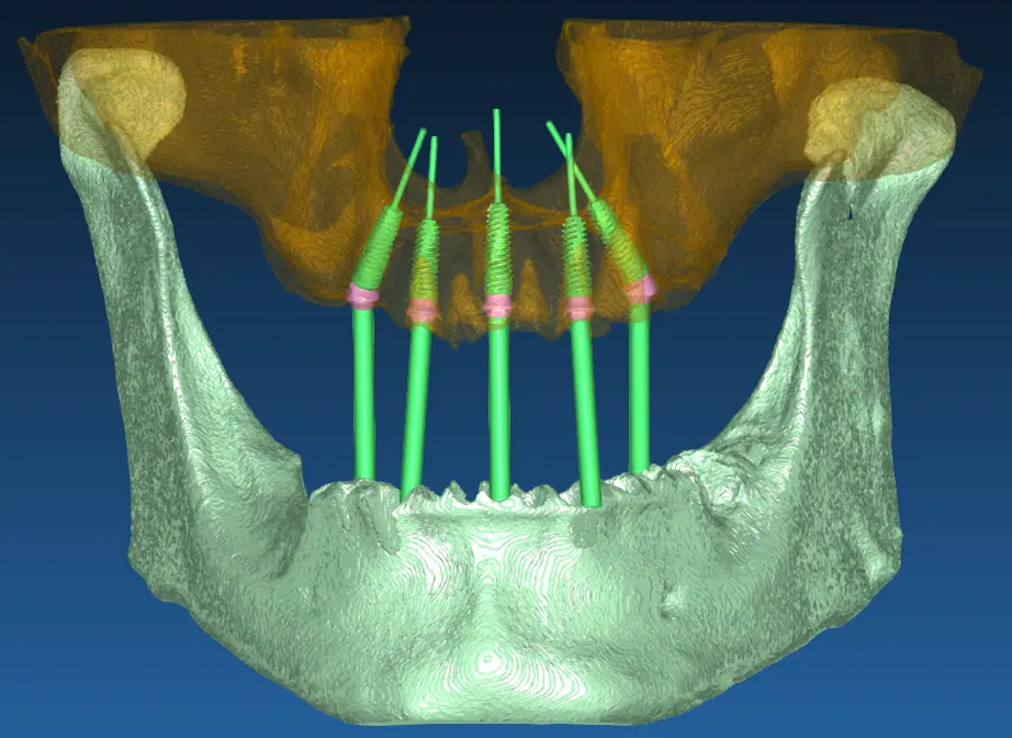 Full-arch All-on-5/6 maxilla surgical plan with fixture angulation and bone volume, designed by MyNaviScan in Chicago