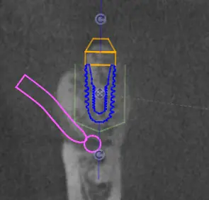 Single dental implant rendered in 3D showing nerve canal proximity, planned by MyNaviScan for a Chicagoland clinic