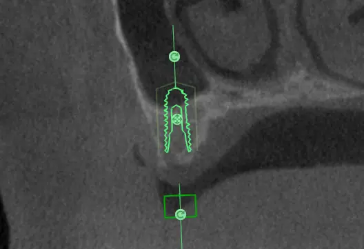 CBCT implant planning view showing implant position relative to the maxillary sinus floor, prepared by MyNaviScan in Chicago